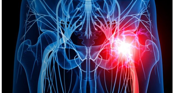 durere la nivelul articulațiilor șoldului în zona inghinală cum să ușurezi rapid durerea în articulația umărului