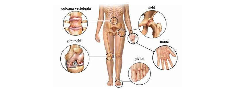 semne de gonartroză a tratamentului articulației genunchiului