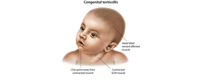 Torticolis Congenital - Apollus Institute