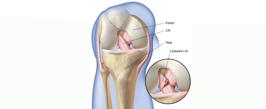 lezarea ligamentelor cruciate ale genunchiului)